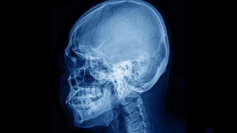 Ученые улучшили «оптическое просветление» тканей черепа